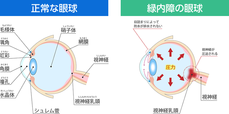 緑内障