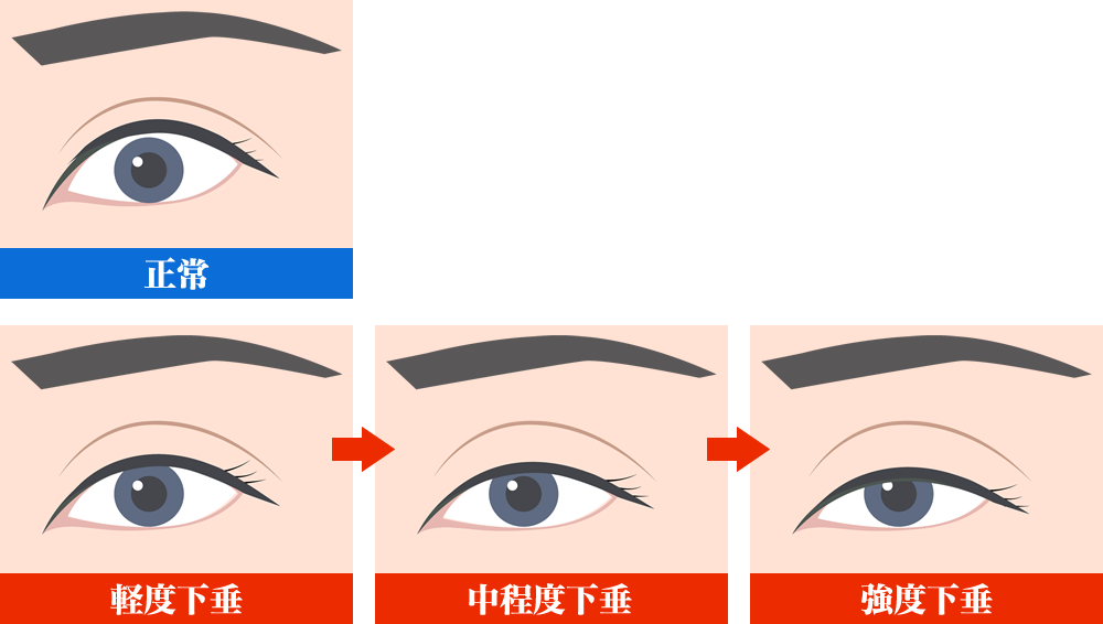眼瞼下垂